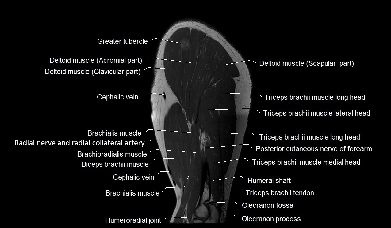 Upper arm (humerus ) saittal cross sectional anatomy 3T image 11.webp